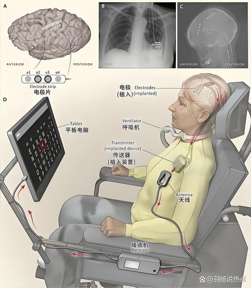 脑机接口(医疗康复应用)(脑机接口简介)